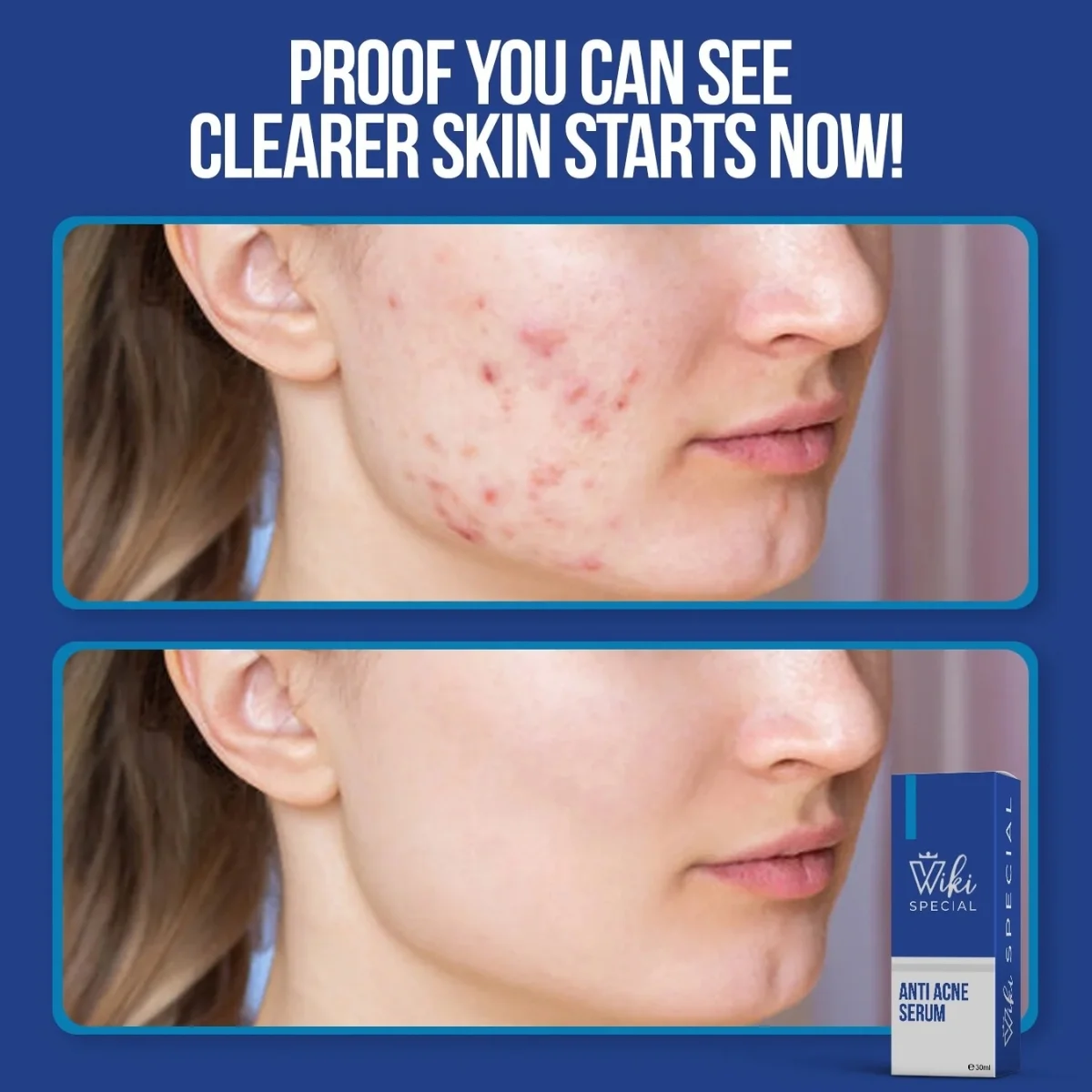 Wiki Special Anti Acne Serum 30ml | Clears Acne & Soothes Skin